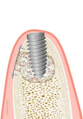 Biocompatible Bone Cement für Präzise Implantation und Stabile Knochenersetzung!