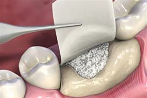  Hydroxyapatite: Revolutionäre Material für Knochenregeneration und Zahnimplantate!