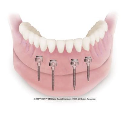  Lactoglass: Der vielseitige Biowerkstoff für fortschrittliche Implantate!